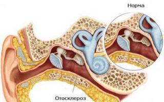 Лечение шума в ушах и головокружения, их причины Чем лечить шум в ушах и головокружение